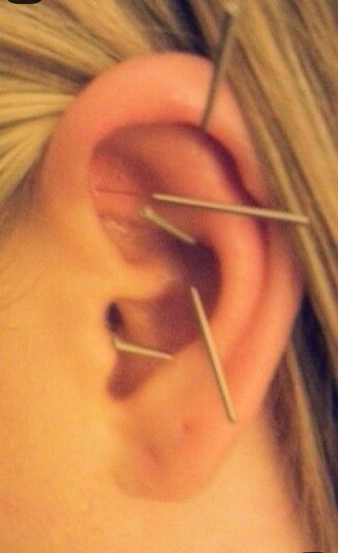 Ear with tiny acupuncture needles and seeds placed on auricular points